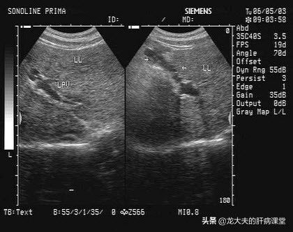 探究早期肝硬化的无声信号: 肝硬化的彩超检查分析