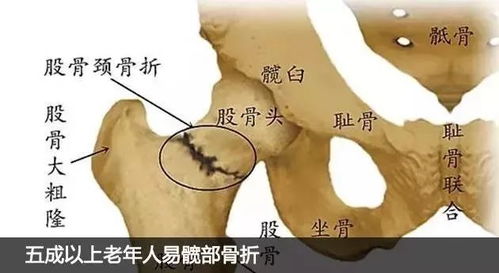 高龄男子因痛风石导致严重并发症，骨折风险极高