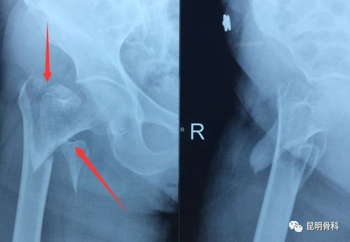 高龄男子因痛风石导致严重并发症，骨折风险极高