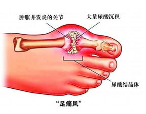 深入了解高尿酸血症与痛风的诊疗之路：详述步骤与建议