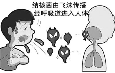 全球关注：肺结核仍在肆虐，持续挑战公共卫生体系