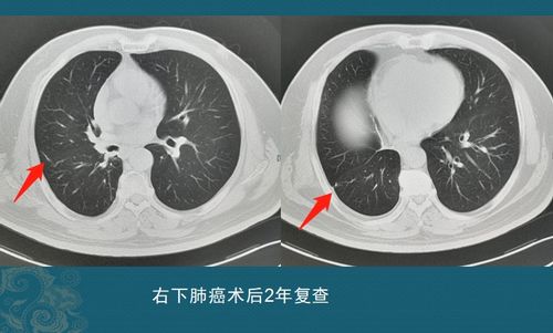 掌握肺癌淋巴结转移的最新信息：是否意味着晚期？