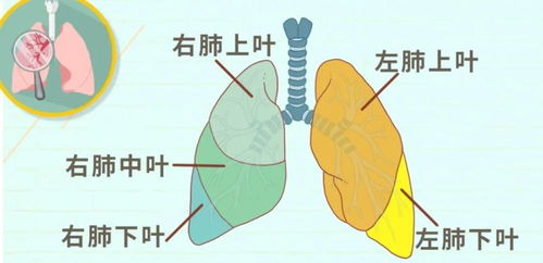 切掉肺叶后，肺功能的严重程度与恢复方式的影响分析