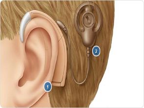 多地开始推广人工耳蜗纳入当地医保报销政策，有望让更多患者受益