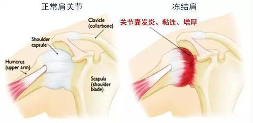 揭秘：为何肩部会“冻结”，如何有效预防肩周炎