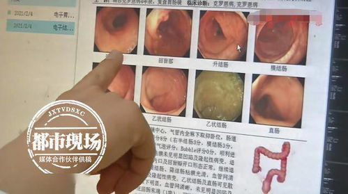 男孩多年腹泻被诊断为绿色癌症,病因揭示:可能与网络使用有关