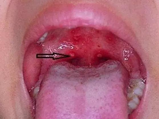 疱疹性咽峡炎：为何近期多地频发？医生紧急提醒需加强防护！