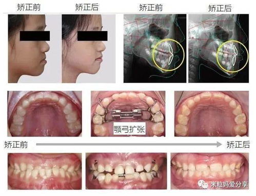 儿童牙齿矫正低龄化的趋势及家长应对策略分析