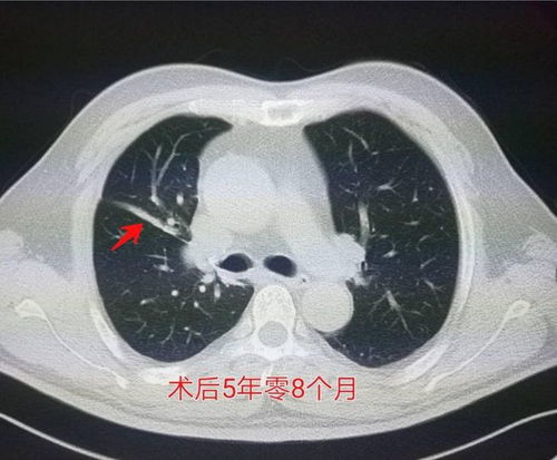 肺结节与钙化：无需过度担忧，这可能是肺癌的信号