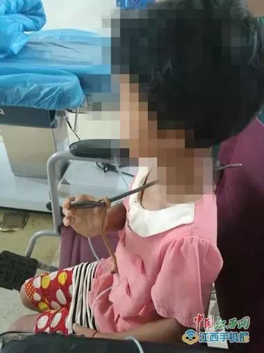 19岁少女因吃烧烤不幸喉咙刺穿，食品隐藏致她遭受三个月折磨