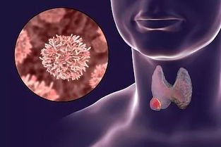详解甲状腺结节的细胞学检查准确率，真相究竟如何？专家给出明确答案