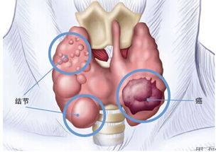 详解甲状腺结节的细胞学检查准确率，真相究竟如何？专家给出明确答案