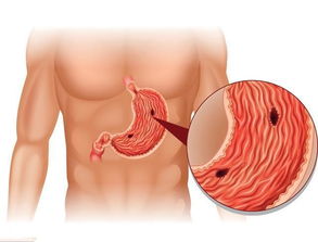 揭示神秘的肿瘤：反复胃溃疡竟可能成肿瘤，诊断时间长达五年或七年