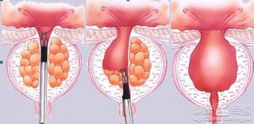 寻求重度前列腺增生日间手术的治疗方案