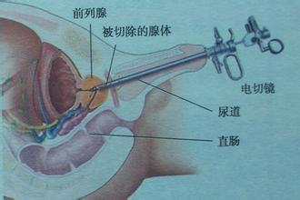 寻求重度前列腺增生日间手术的治疗方案