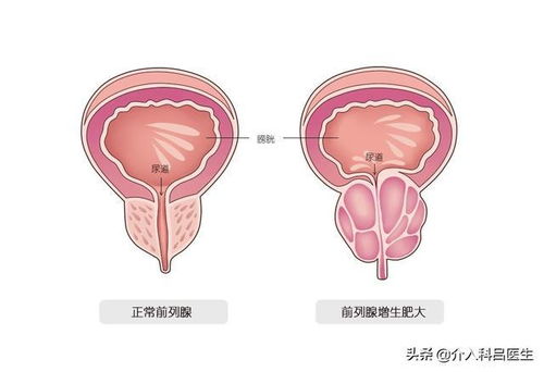 寻求重度前列腺增生日间手术的治疗方案