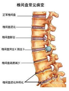 专家建议：10岁以下儿童应避免持续性下腰训练，因可能导致脊髓损伤并截瘫