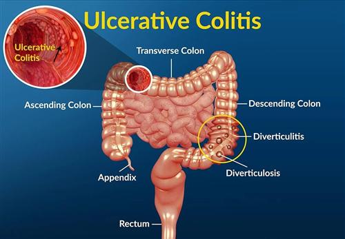 全面了解与掌握：溃疡性结肠炎的自我治愈方法——益生菌前六强联合用药指南