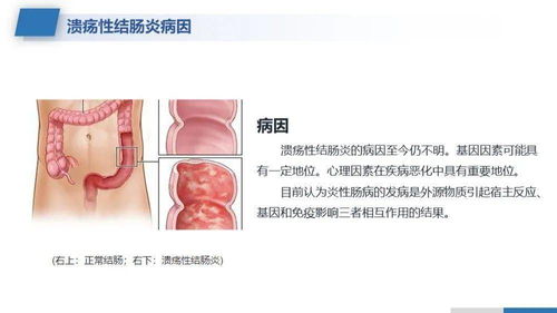 全面了解与掌握：溃疡性结肠炎的自我治愈方法——益生菌前六强联合用药指南