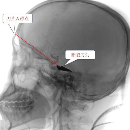 「刀片嗓」病根在于脑部，专家为您一击破顽疾