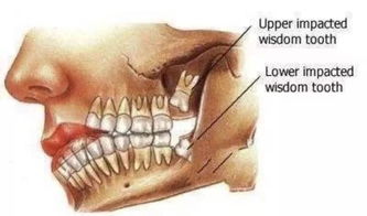 不容忽视的长期隐患：长智齿将烂穿下颌！年轻人需重视