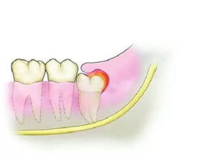不容忽视的长期隐患：长智齿将烂穿下颌！年轻人需重视