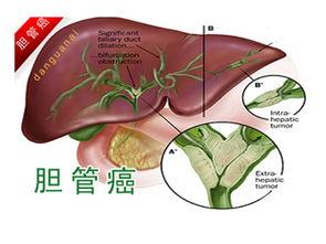 年轻男性教师患胆管癌去世：为什么这个疾病如此残酷