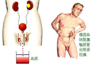 隐形的肾癌：不被察觉的肾上肿瘤，定期体检很重要！

腹部肿块背后隐藏的肾上肾癌：早发现、早治疗的重要性