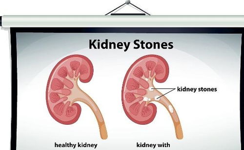 震撼！看完演唱会后，专家详解肾结石能否自动排出的关键因素