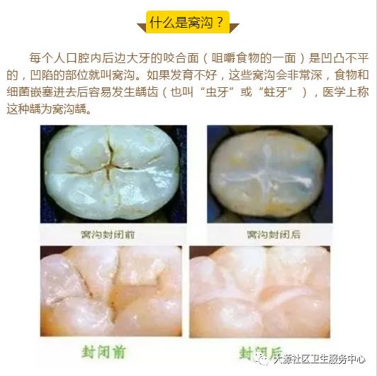 宝宝患龋齿后，窝沟封闭是否安全？全面解析与解答