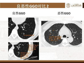 肺部磨玻璃结节切除了，还有必要治疗吗？关注这个问题，避免不必要的医疗费用和健康损伤