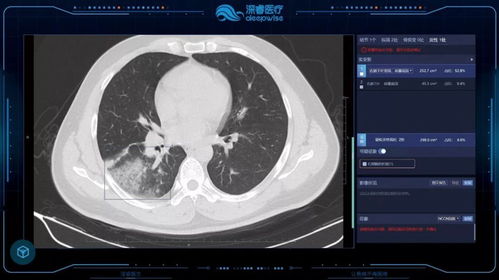网络检索+医疗解读：深入解析肺部CT报告的14个关键词