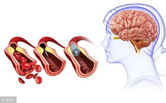 揭秘脑卒中病人降压治疗的关键点：医生详细解读