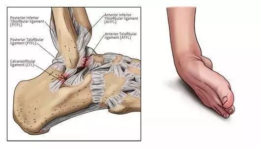 如何正确处理崴脚后，防止留下后遗症