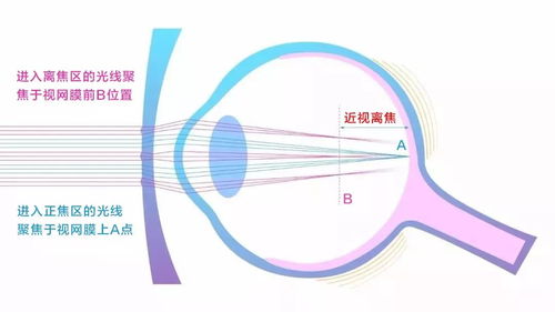 OK镜，儿童近视防控神器，让视力无忧成长