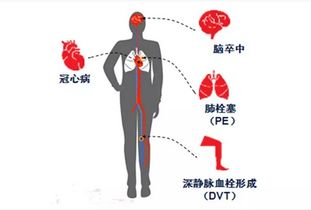 急性脑梗发病后，抢救时间从4.5小时扩展到24小时的详细解读