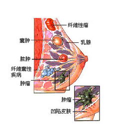 20年研究揭示：双乳切除可降低对侧乳腺癌风险，却不会显著提升生存率