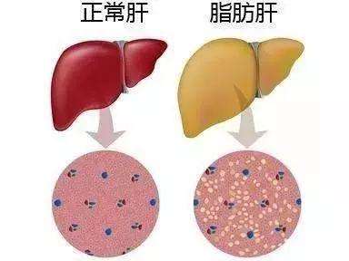 为何瘦人也能患上脂肪肝，而您的体脂才仅17%呢？了解一下原因吧！