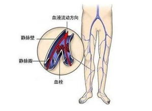 您的腿部可能被网络上的信息打乱，下肢也可能因此出现血液问题