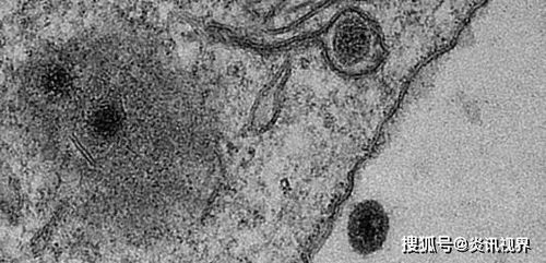 科学家揭示多发性硬化症与古代 DNA 病毒之间可能的神秘联系