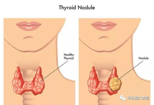 徐若瑄因确诊甲状腺癌需关注甲状腺结节