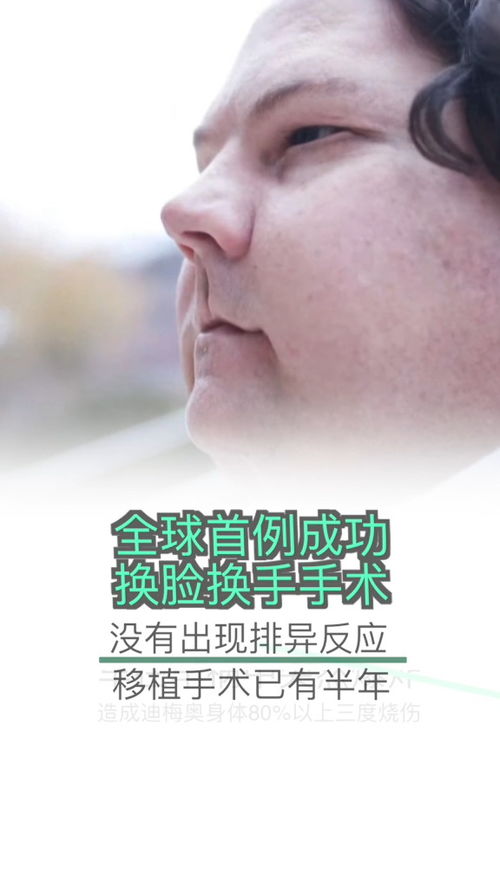 全球首例成功换脸换手男子即将举行婚礼，让身份得以瞬间转变