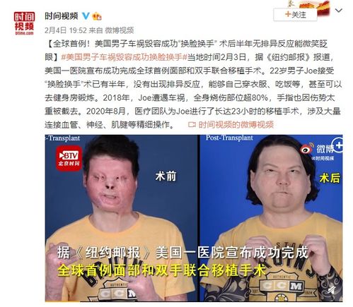 全球首例成功换脸换手男子即将举行婚礼，让身份得以瞬间转变